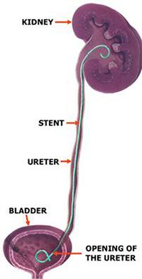 double j ureteral stent